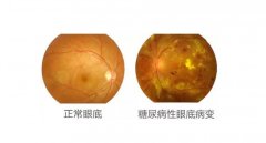 基于中医体质的2型糖尿病视网膜病变的氢分子医学探讨