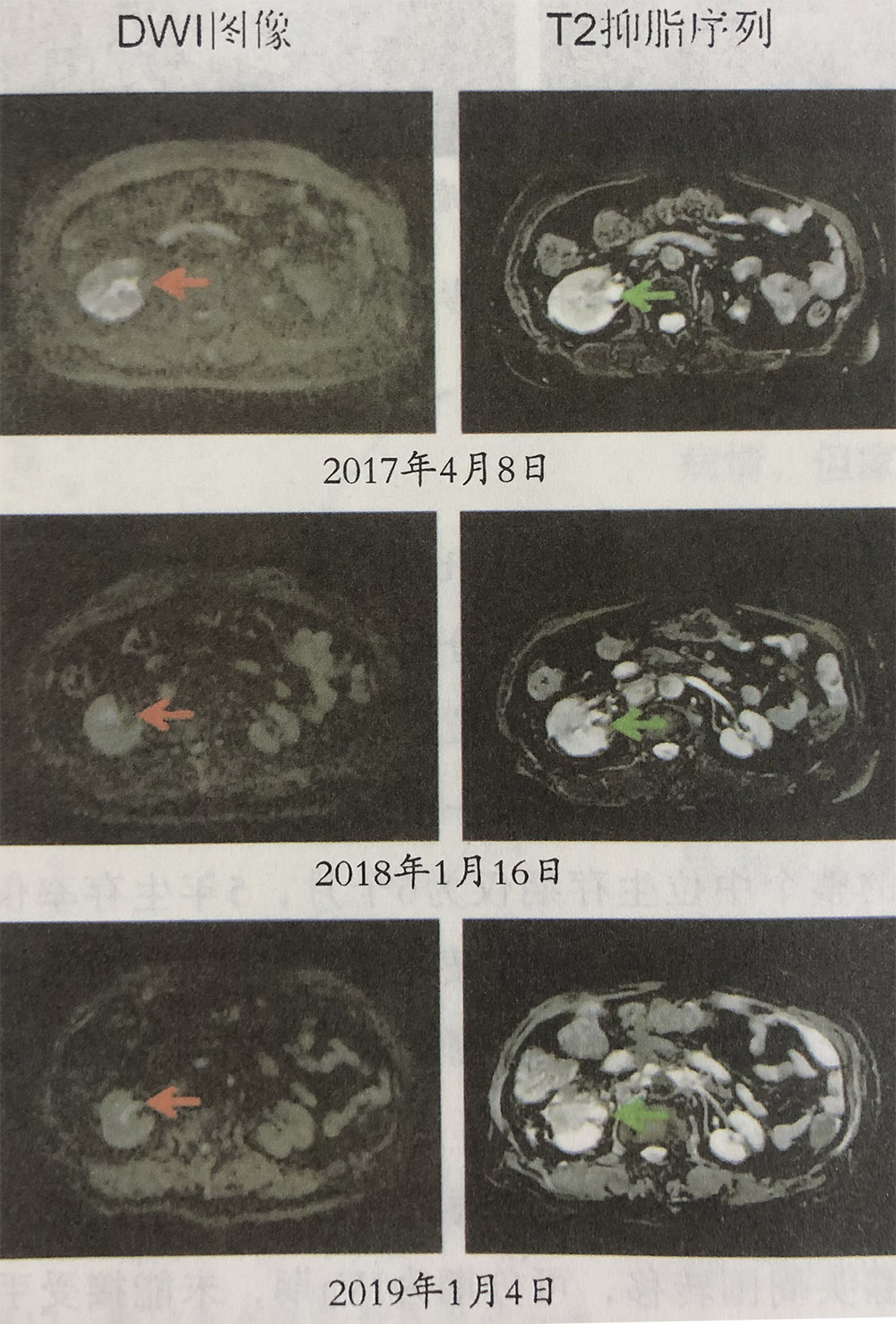 输尿管腺癌的氢气辅助作用，吸氢前后比较