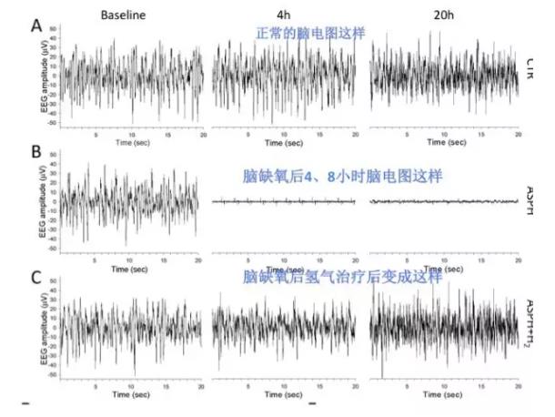 匈牙利：氢气适用于缺氧脑损伤的神奇作用